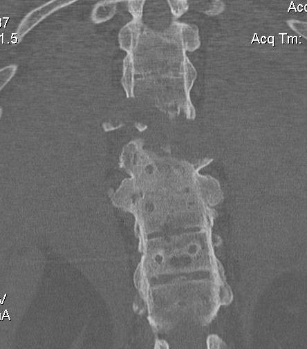 Ankylosing Spondylitis Thoracic Fracture CT Coronal